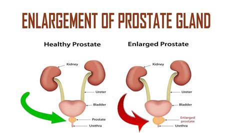 Prostate Gland Symptoms
