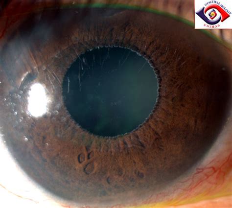 Sarawak menyaksikan 12,336 orang menerima dos pertama manakala 34,270 menerima dos. Atlas of Ophthalmology: Pseudoexfoliation syndrome by ...