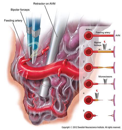 Cerebral Arteriovenous Malformations Seattleneurosciences Com