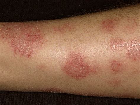 Nummular Eczema Pictures Treatment Causes Symptoms Diagnosis