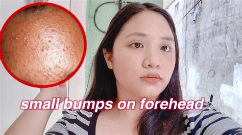 How To Get Rid Of Tiny Bumps On Foreheadface Fast 3 Days Only