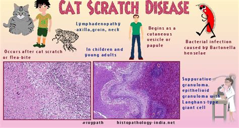 Cat Scratch Disease Neck