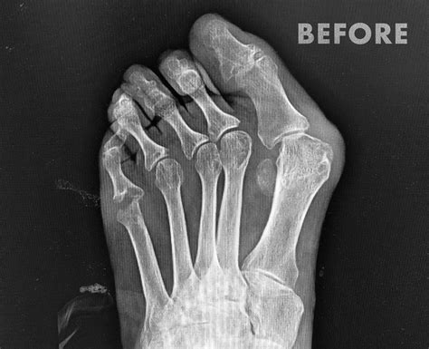 Hammertoe Repair — Reign Medical