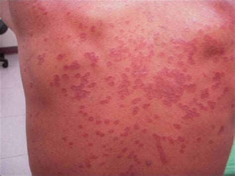 Multiple Annular Erythematous Plaques On The Back Indian Journal Of