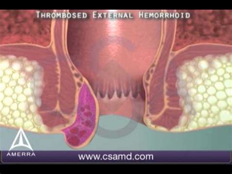 Thrombosed External Hemorrhoid D Medical Animation YouTube