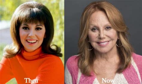 Marlo Thomas Plastic Surgery Before And After Photos Latest Plastic