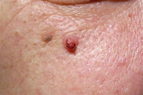 Seborrhoeic Wart On Cheek Photograph By Dr P Marazziscience Photo Library