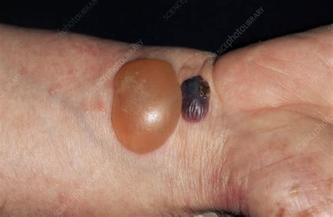 Bullous Pemphigoid Blisters Stock Image M2400553 Science Photo