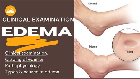 Edema Clinical Examination Grading Pathophysiology And Types Of Edema