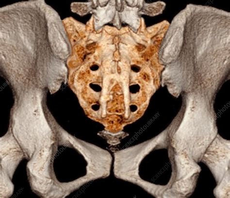 Rear Of Pelvis And Base Of Spine 3d Ct Scan Stock Image C0371514