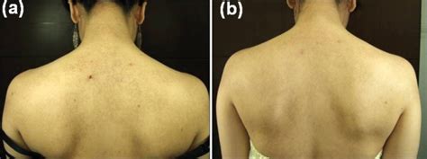 A 18 Year Old Female Patient With Keratosis Pilaris Patient 5 Showed