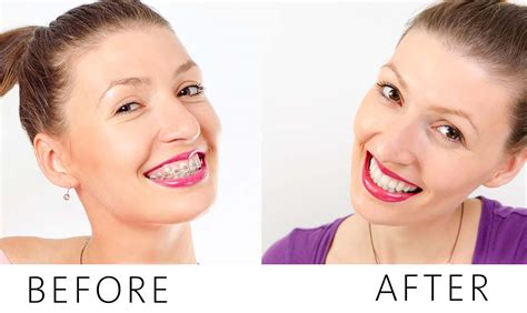 Improve Smile With Orthodontics Orthodontic Benefits You Didnt Know