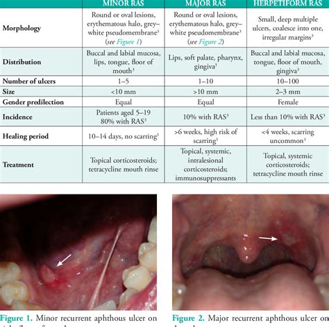 Figure 2 From Overview Of Common Oral Lesions Semantic Scholar
