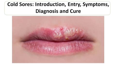 Cold Sores Introduction Entry Symptoms Diagnosis And Cure