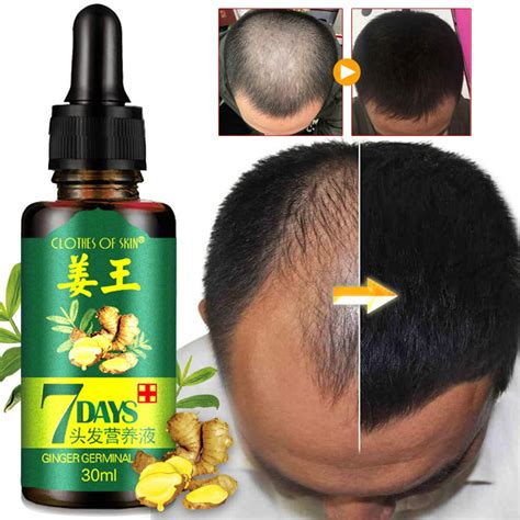 Alvage Ginger Germinal Oil Hair Growth Essential Oil Hair Loss Treatment For Thicker Dense Hair