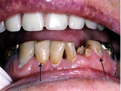 10 Root Caries Pocket Dentistry