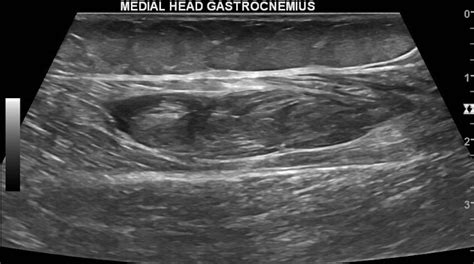 Gastrocnemius Vein Ultrasound