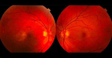 Blog Eye Specialists Centre Retina And Macula Cataract And Glaucoma