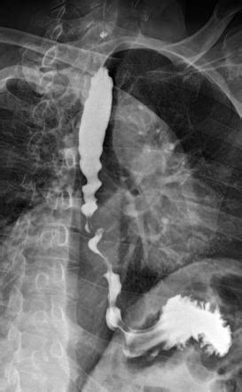 Diffuse Esophageal Spasm Corkscrew Esophagus Image Radiopaedia Org