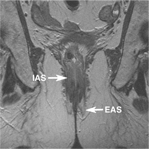 mri in evaluating atrophy of the external anal sphincter in patients with fecal incontinence ajr