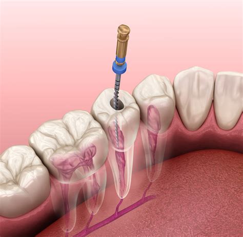 Dental Crowns After Root Canal Treatment Gilbert Dentist Premier