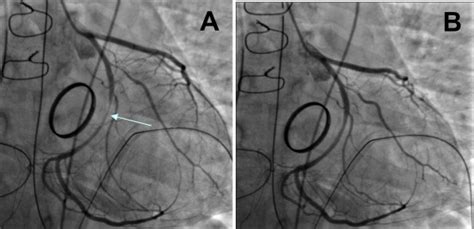 Long Term Outcome After Annular Mechanical Mitral Valve Replacement In