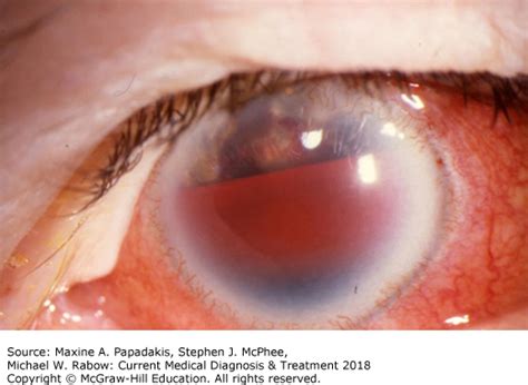 Glaucoma Pathophysiology Ppt Astigmatism Glaucoma Swollen Eyes Disease