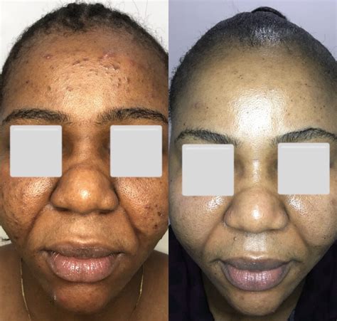 Chemical Peel Free Insights On What Happens When You Have A Chemical