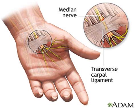 Carpal Tunnel Adelaide Plastic And Hand Surgery