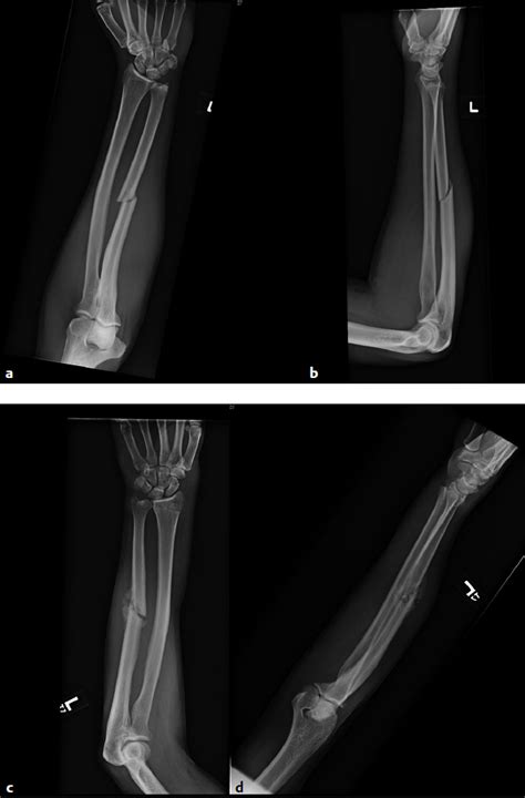 Forearm Fractures Clinical Presentation History Physical Examination