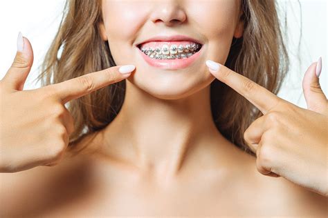 How Long Do Braces Take To Straighten Teeth Mill Creek Orthodontics