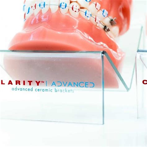 3m Clarity Clear Braces Larson Orthodontics In Alexandria Va