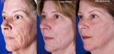 TRL Facial Laser Resurfacing Lake Oswego Aesthetics LLC