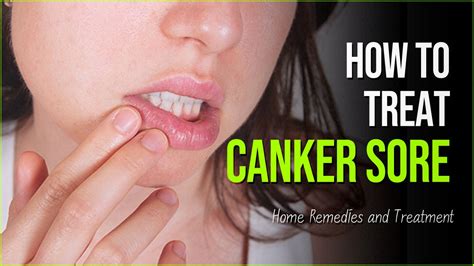 Canker Sore Guide To Treating And Preventing The Painful Sensations