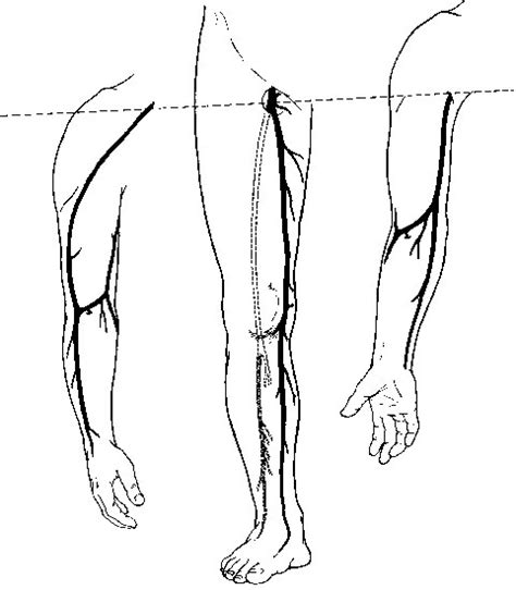 Arm Veins For Lower Extremity Arterial Reconstruction Thoracic Key