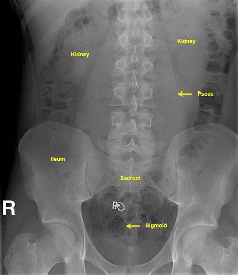 Unique How To Interpret An Abdominal X Ray Non Chronological Report Tes