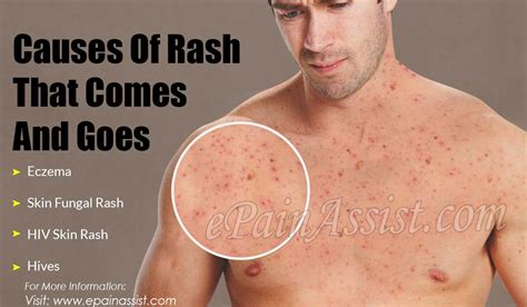 Hiv Rash Early Symptom Of A Serious Disease Ucsf