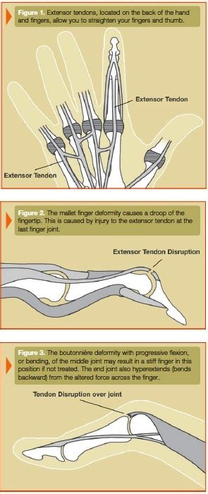 Extensor Tendon Injuries New York The New York Hand And Wrist Center