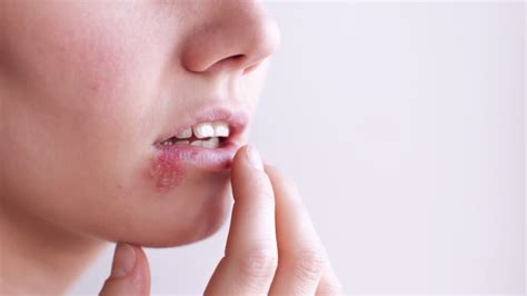Get Rid Of Lip Pimples Swollen Big Painful Upper Inside Around Your