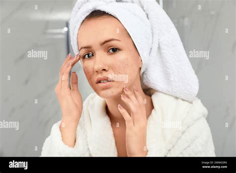 Acne Rosacea Hi Res Stock Photography And Images Alamy