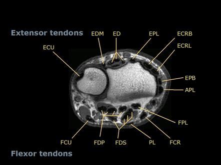 Wrist Tendons Topographic Anatomy Radiology Case Radiopaedia Org