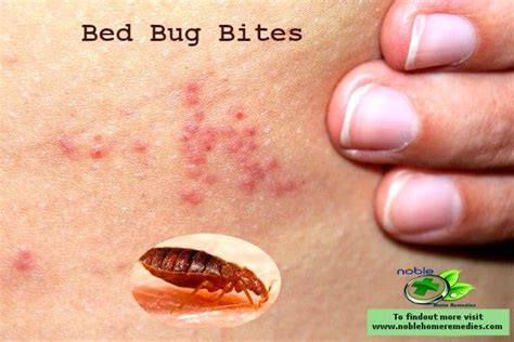 How To Heal Bed Bug Bites Overnight Wasaga Beach Break Fast Ca