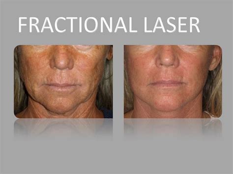 Dr Prinou Call Us Free On 801 801 1100 Fractional Laser Before