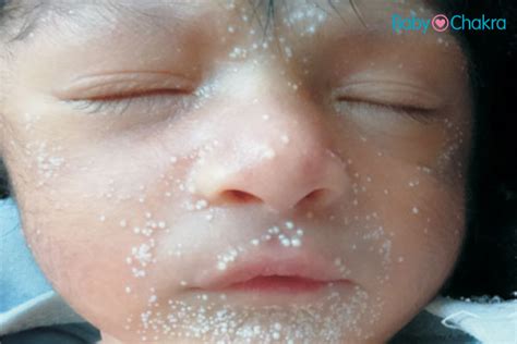 Milia In Newborn Babies Dr Soonu Udani Explain The Causes Symptoms