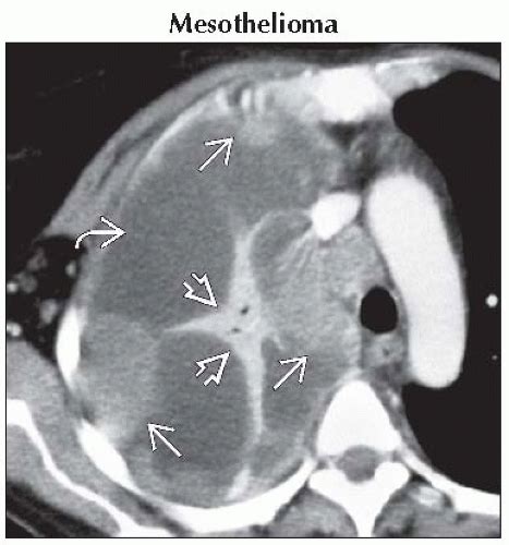 Causes of pleural effusion that can be effectively treated or controlled include an infection due to a virus, pneumonia or heart failure. Unilateral Pleural Effusion | Thoracic Key