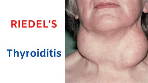 Riedels Thyroiditis Rock Hard Thyroid Stony Hard Woody Thyroid