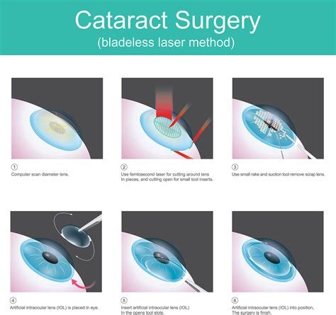 Laser Cataract Surgery Azar Eye Clinic