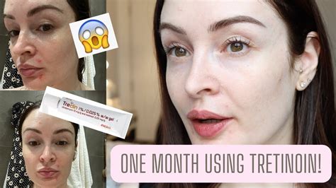 1 Month Of Using Tretinoin Before And After Youtube