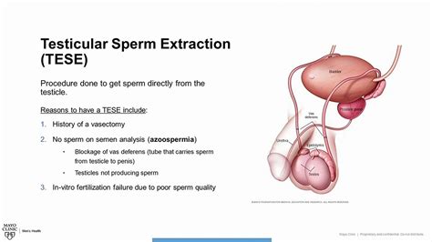 Testicular Sperm Extraction Tese Procedure Overview Youtube