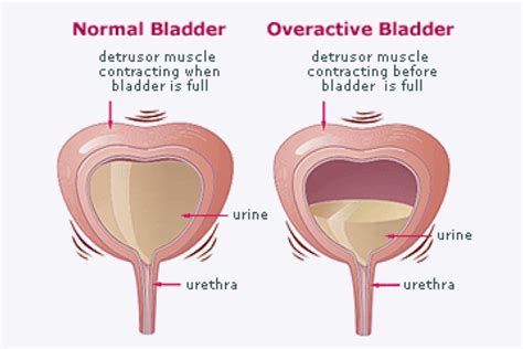 Overactive Bladder Syndrome Vs Urge Incontinence